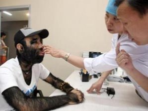 Самый волосатый человек решил сделать лазерную эпиляцию