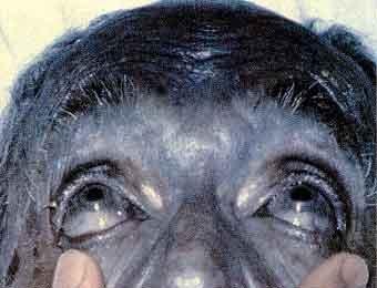 В США живет синий человек (ФОТО)