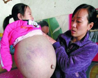 Медики спасли "беременную девочку" из Китая