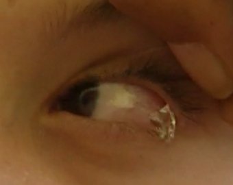 У ливийской девочки из глаз выделяются кристалы из соли