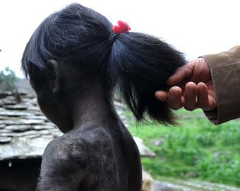 В Китае родилась  девочка, покрытая шерстью