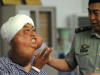 Китаянке удалили 70 опухолей, обезобразивших ее лицо