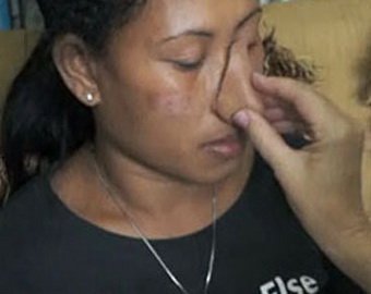 30-летняя жительница Индонезии жила без носа три года