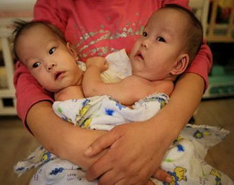 В Китае мать выбросила на улицу сиамских близнецов 