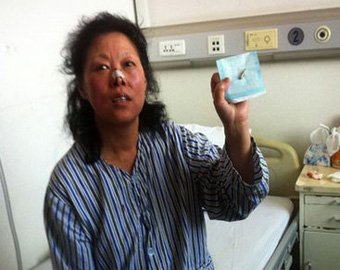 Китаянка 40 лет прожила с пулей в голове