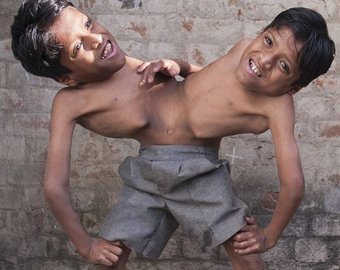 В Индии поклоняются сиамским близнецам