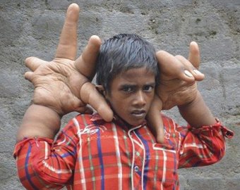 В Индии живет мальчик с гигантскими пальцами