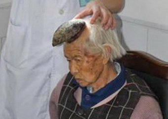 У пожилой китаянки на голове вырос 13-сантиметровый рог