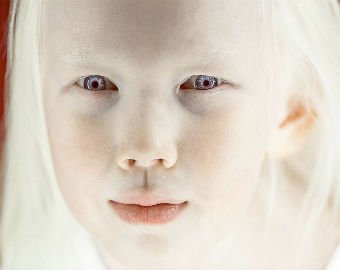 8-летняя девочка-альбинос из Якутии стала звездой Сети