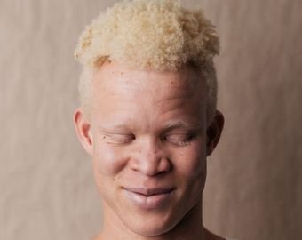 Африканец-альбинос покоряет мир моды
