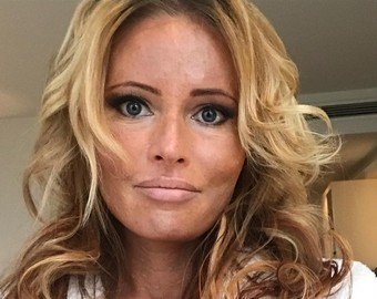 Дана Борисова шокировала поклонников пятнами на лице