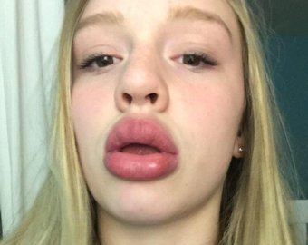 Девушки нашли простой, но небезопасный способ увеличить губы