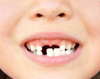 Удален самый длинный человеческий зуб в истории
