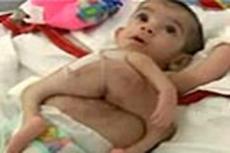 В ОАЭ родился младенец с двумя парами ног