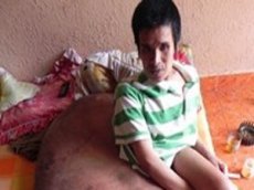 Вьетнамцу удалили опухоль весом 90 килограммов