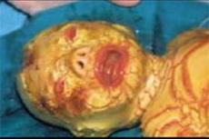 В Саудовской Аравии родился ребенок-змея с глазами наружу