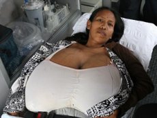 16-килограммовая грудь на полгода приковала перуанку к постели