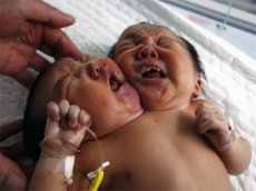 В Китае родился двухголовый младенец