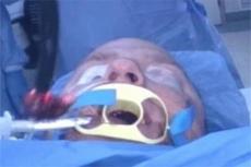 В США удалили аппендикс через рот