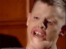 Американцу сделали операцию по полной пересадке лица