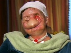 Жертва нападения шимпанзе на шоу Опры Уинфри