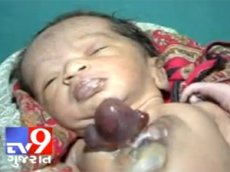 В Индии родился ребенок с сердцем снаружи