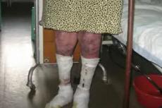 17-летняя девушка едва не сгнила заживо