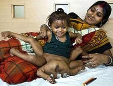Индийскую девочку, которой удалили лишние руки и ноги, показали журналистам