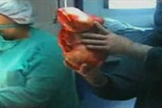 Старушке сделали аборт спустя 46 лет после зачатия