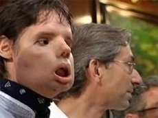 Человека с пересаженным лицом показали общественности