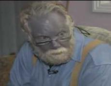 Человек посинел из-за косметического средства от веснушек