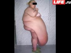 Врачи прооперировали женщину с гигантским животом