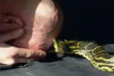 Житель Магнитогорска не чувствует боли