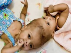 Врачи разделили сиамских близнецов, сросшихся головами