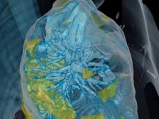 3D-модель лёгких пациента, которые разрушает CoViD-19