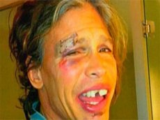 Стивен Тайлер показал синяки и выбитые зубы