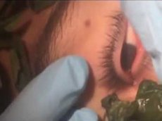 Подросток больше месяца жил с червём в глазу