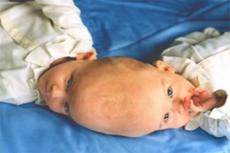 В Германии родились сиамские близнецы, сросшиеся головами