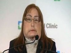 Американка показала общественности пересаженное лицо