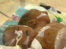 В Индонезии родился двуглавый ребенок