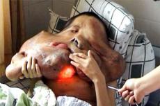 Самую большую опухоль в мире удалили и заспиртовали