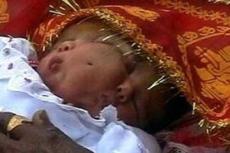 Девочку с двумя лицами не будут оперировать