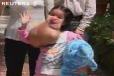 7-килограммовая опухоль на лице 15-летней девочки