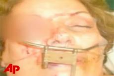 В Америке прооперирована женщина, получившая тяжелую лицевую травму из-за крючка для одежды