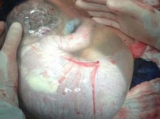 Врачи сняли на видео уникальное рождение малыша «в рубашке»