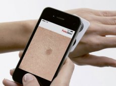 Испанские медики запустили приложение для диагностики рака кожи