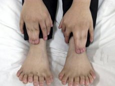 Китайские медики избавили мальчика от лишних пальцев