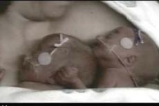 Канадка родила четверых однояйцевых близнецов A, B, C и D