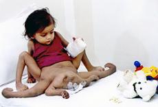 Девочке с восемью конечностями удалили все лишнее