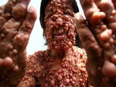 В Индии живет человек-пузырь